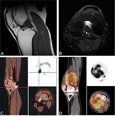 Case Report: Pulmonary Metastases From Epithelioid Sarcoma in Extremity Favourably Responding to Immunotherapy With Camrelizumab